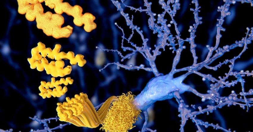 infrared lasers destroy amyloid plaques in Alzheimer's disease simulations