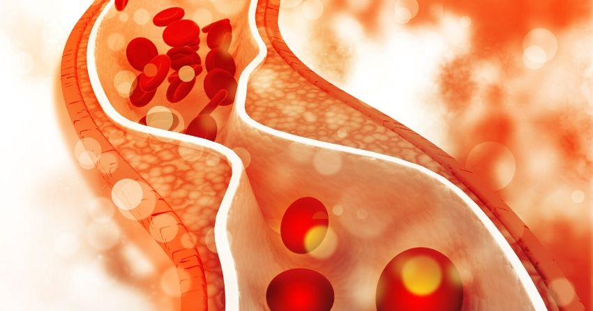 atherosclerosis, plaque buildup in artery