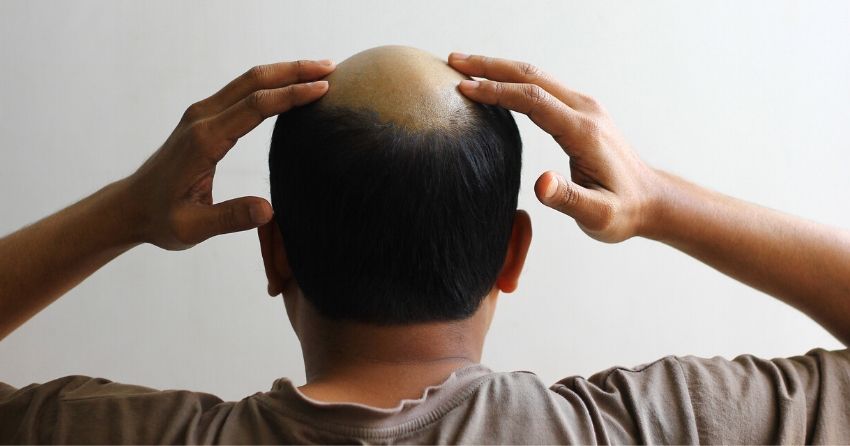 a topical stem cell treatment may help to treat male pattern baldness and regrow hair