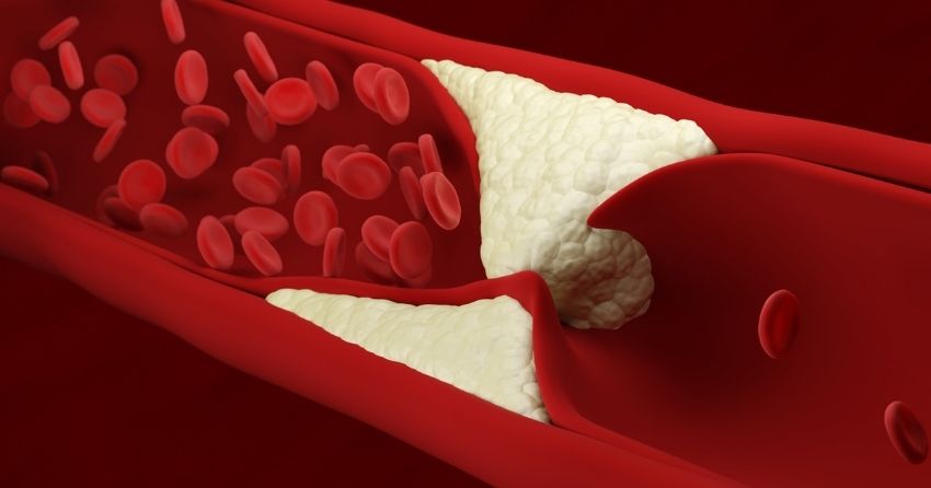New Protein Found That Blocks Body's Ability to Clear Bad Cholesterol
