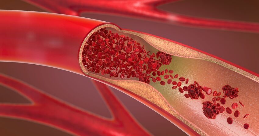 narrowing artery with blood clot