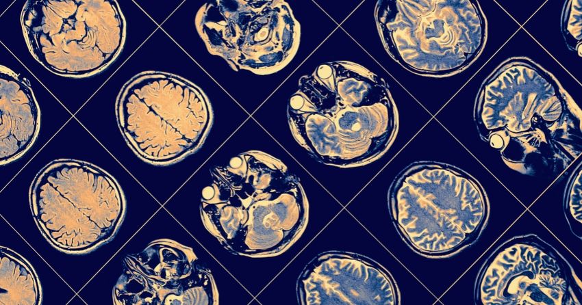 alzheimer's disease brain scan 