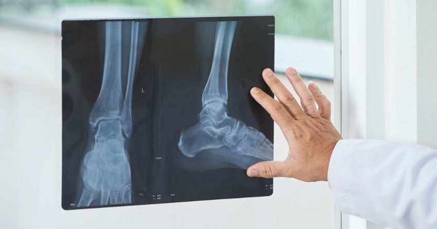 Skeletal Age Calculator Predicts Bone Fracture Risk