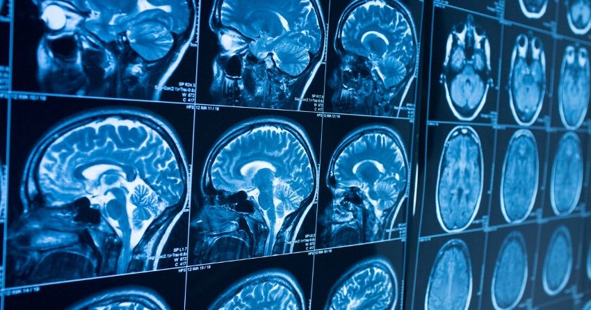 mri brain scan, alzheimer's disease